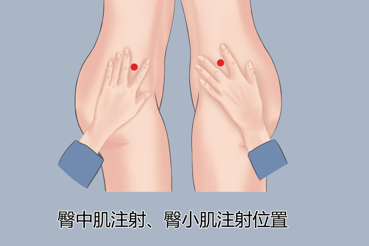 臀中肌、臀小肌注射位置示意图