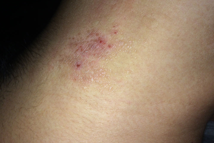 颈部癣后期中央色素沉着图