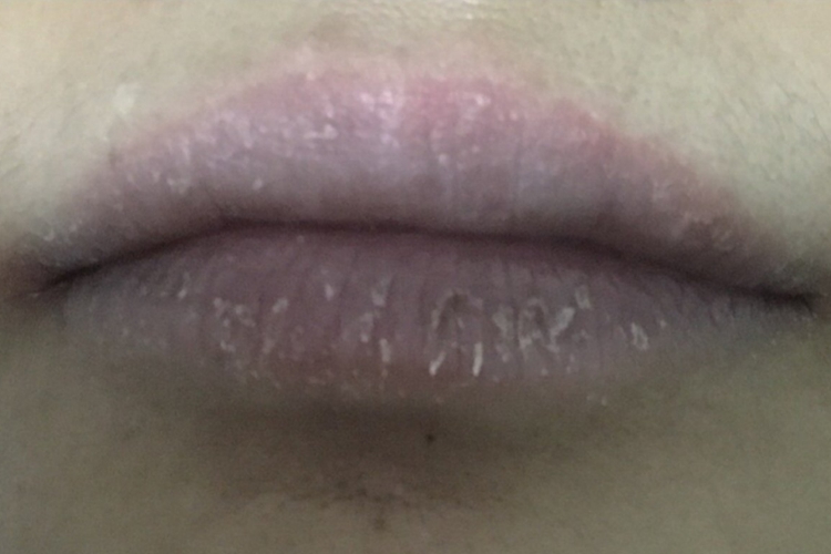 慢性光线性唇炎脱皮图 慢性光线性唇炎脱皮图