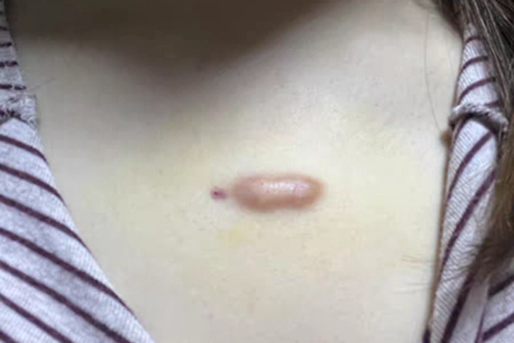 瘢痕疙瘩胸部有硬疙瘩图