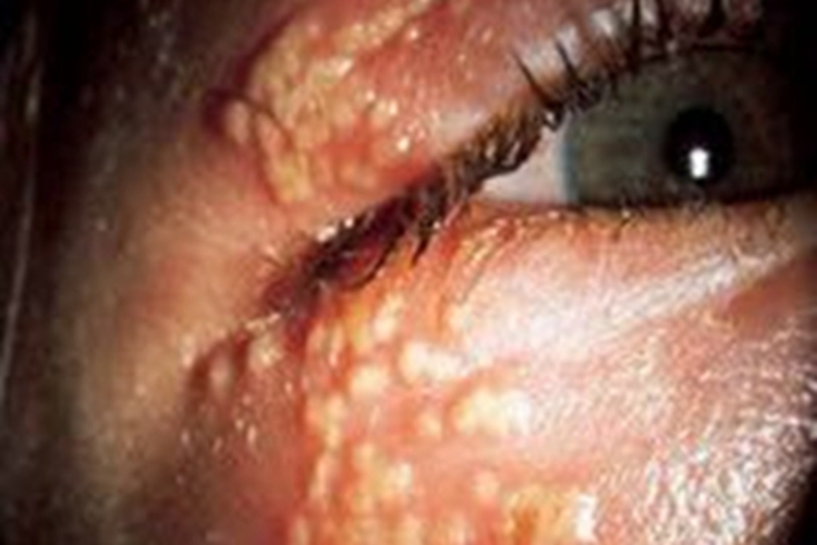 病毒性睑皮炎眼周小水疱图