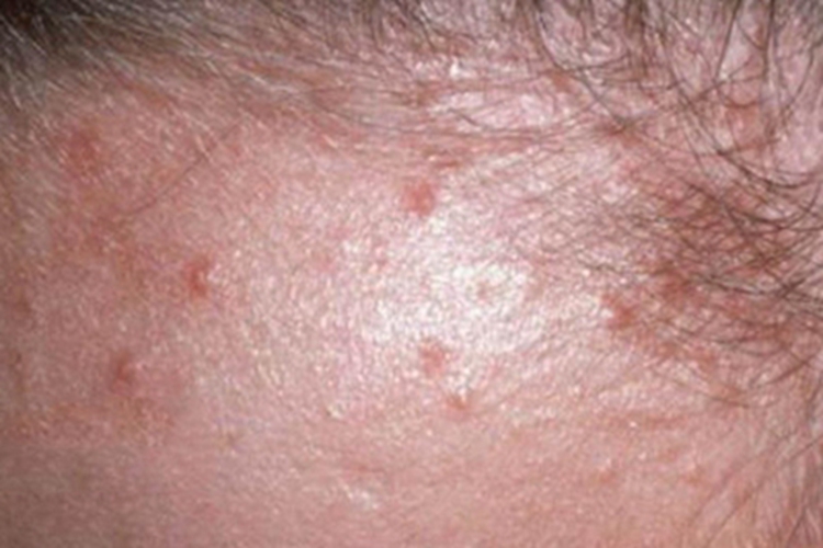 毛囊炎前额出现丘疹图