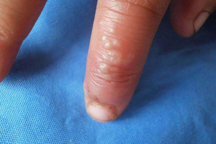 手部单纯疱疹图 手部单纯疱疹图