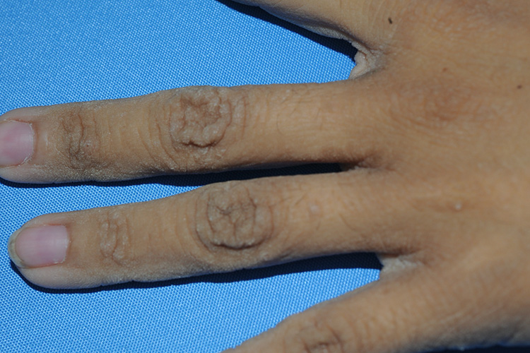 掌趾角化图 掌趾角化图