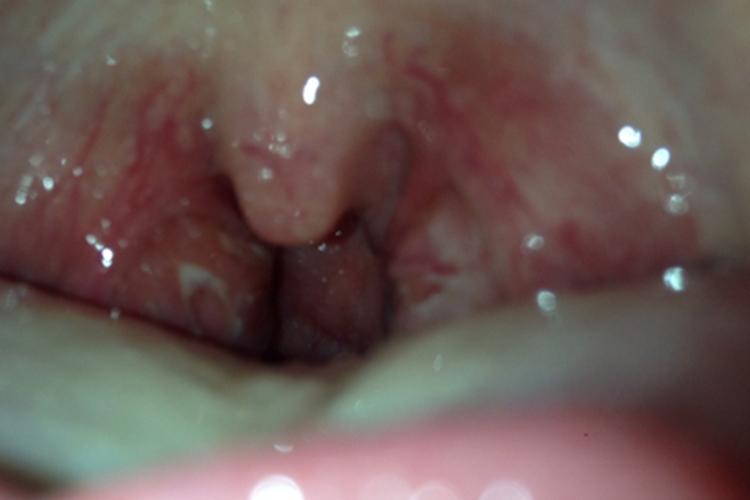 喉蛾局部充血症状图