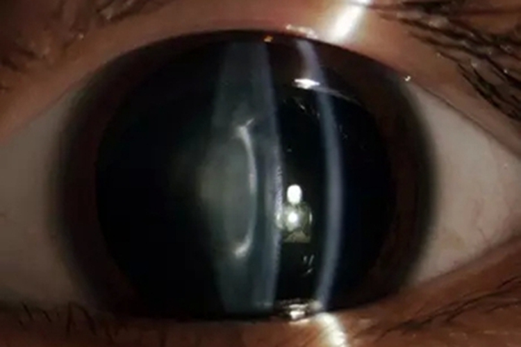 后囊下白内障白斑图