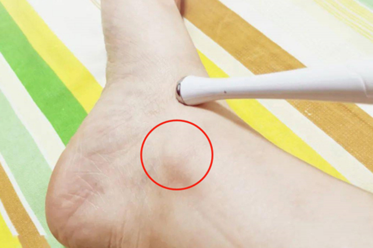 脚内踝骨性凸起图