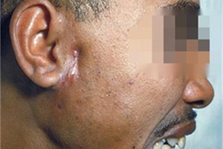 面颈部放线菌病耳前瘢痕图