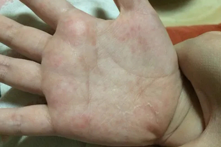 小孩手掌心湿疹图