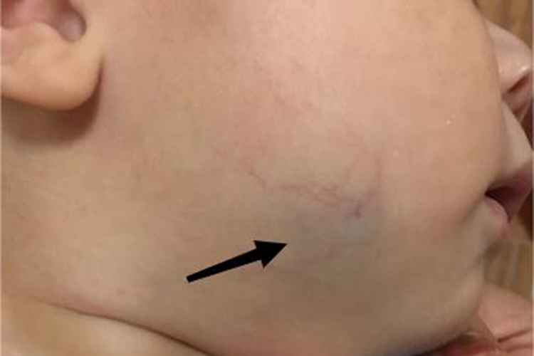 海绵状血管瘤面部症状图