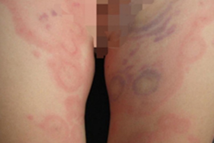 低补体血症型大腿红斑图