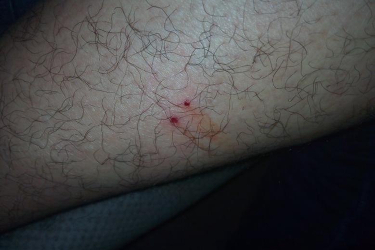 蜈蚣咬完人的牙印图