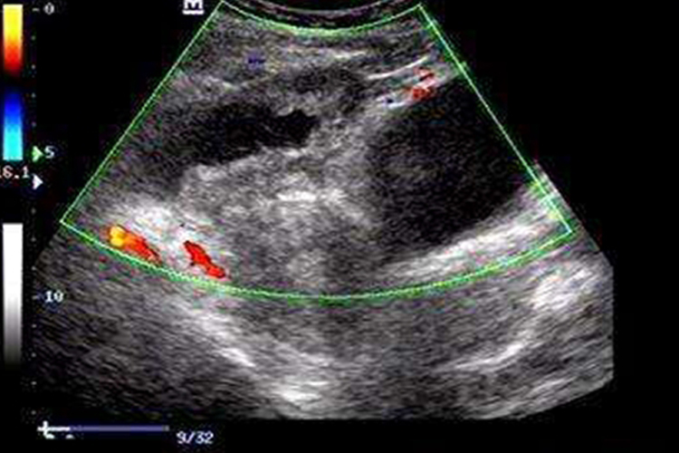 卵巢囊肿蒂扭转典型超声图 卵巢囊肿蒂扭转典型超声图