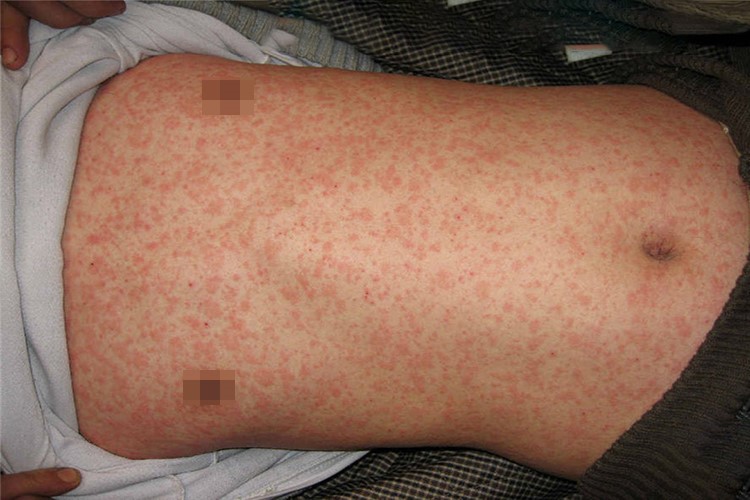 麻疹样药疹图