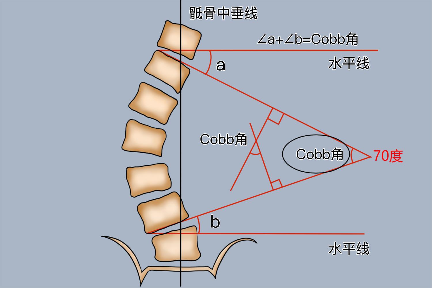 驼背70度标准示意图