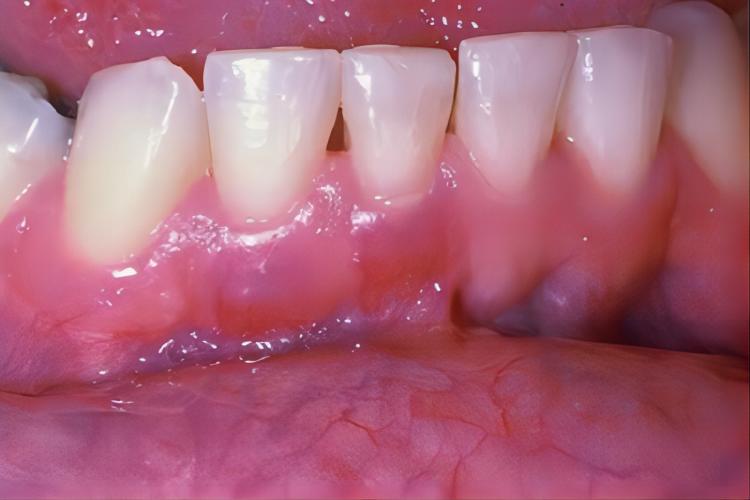 牙龈炎下牙龈萎缩图