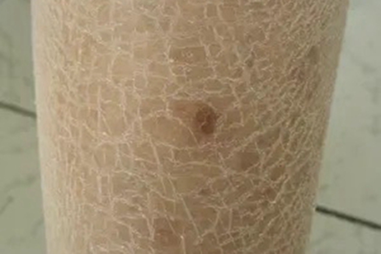 皮脂缺乏症小腿条纹图 皮脂缺乏症小腿条纹图