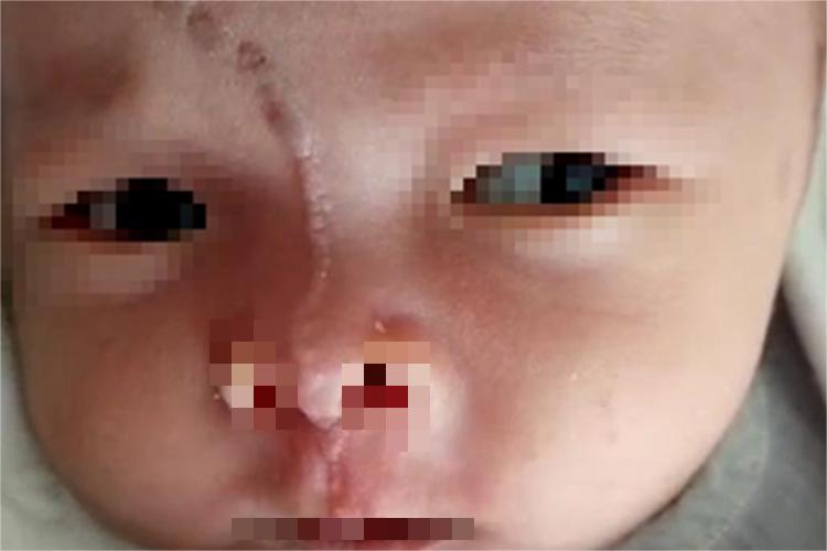 线状疣状表皮痣症状图