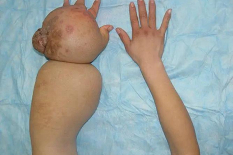 丝虫性淋巴水肿皮肤水肿图 丝虫性淋巴水肿皮肤水肿图