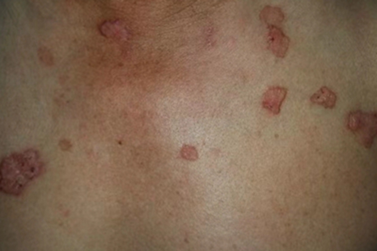 汗孔角化症胸部症状图 汗孔角化症胸部症状图