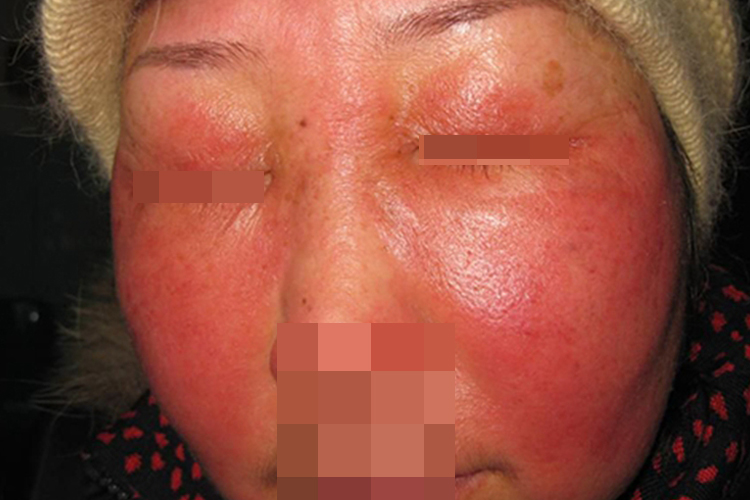 接触性皮炎脸部鼻子红斑图 接触性皮炎脸部鼻子红斑图