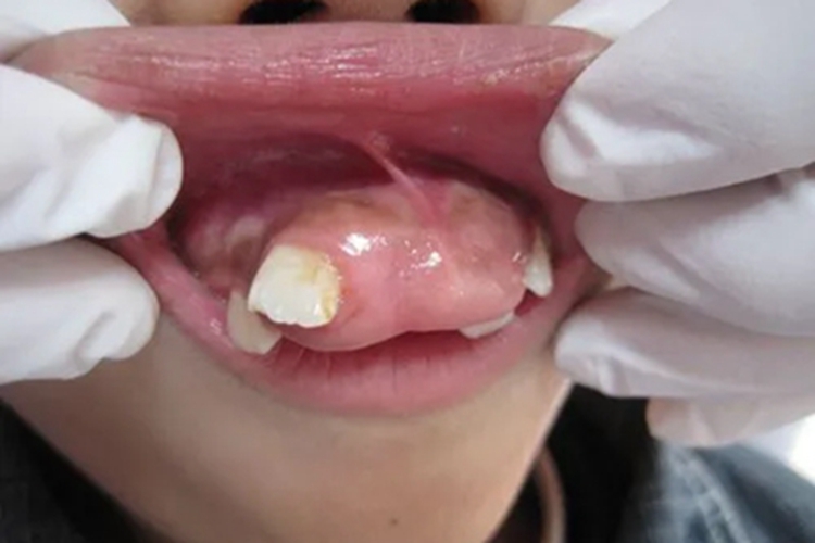 晚期上颌窦癌牙槽变形图