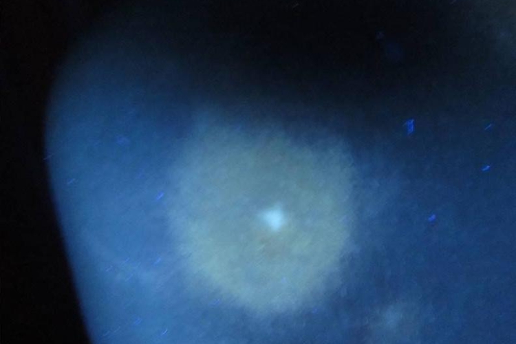 花斑糠疹伍德灯下表现图