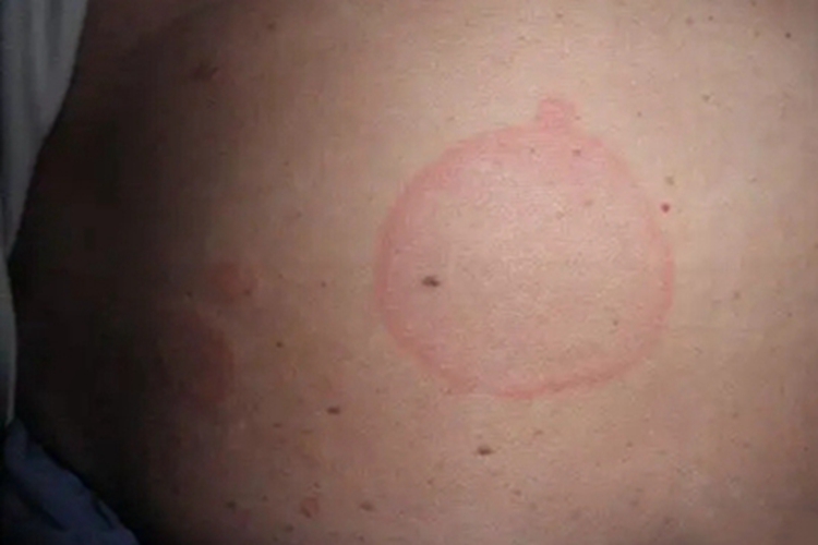 离心性环状红斑腹部红斑图