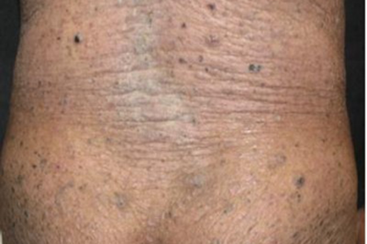 砷角化病腰部长斑图