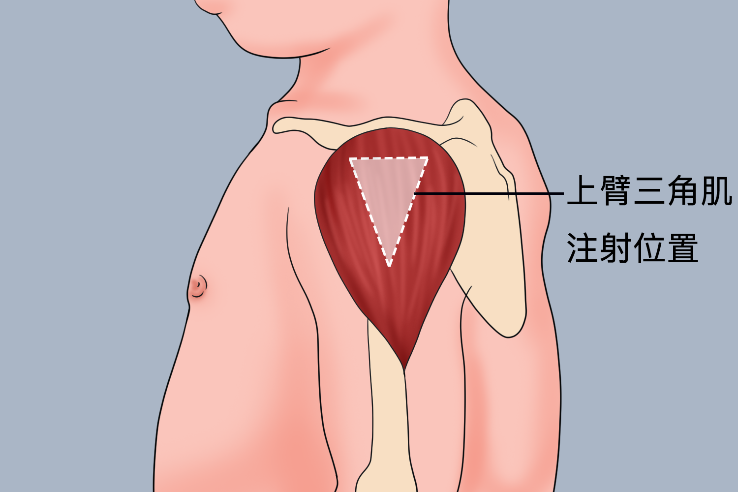 上臂三角肌注射位置图 上臂三角肌注射位置图