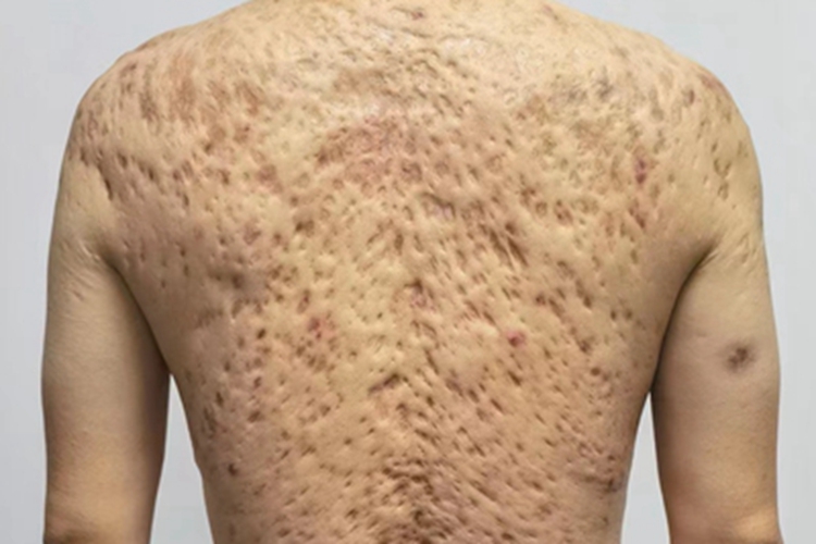 痤疮背部症状图