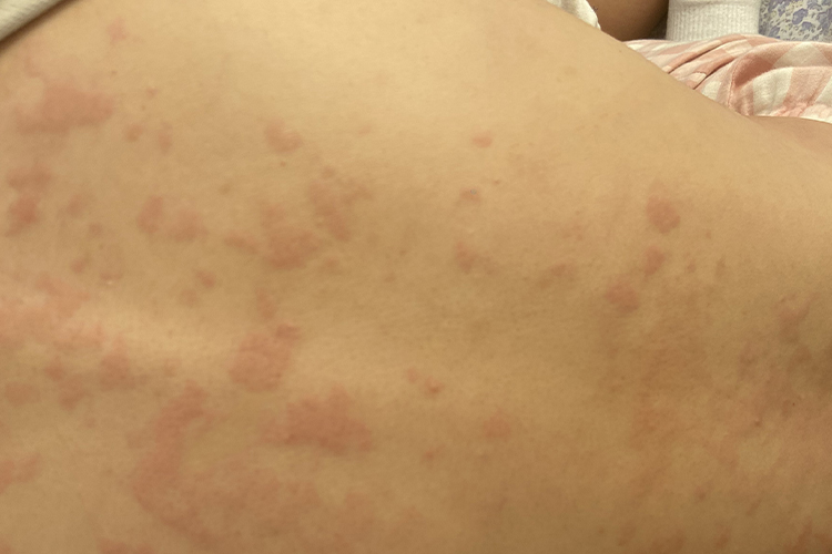 酒精过敏红斑图