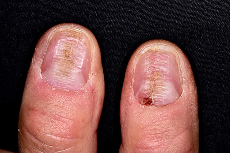 肝不好的指甲早期图片