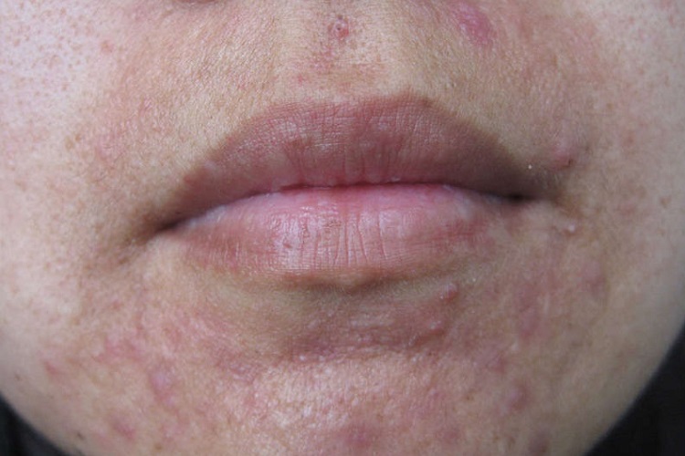 接触性皮炎口周丘疹图 接触性皮炎口周丘疹图