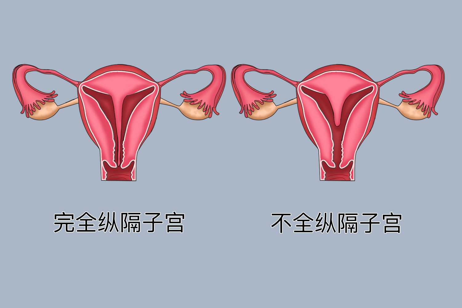 子宫不全纵隔图片