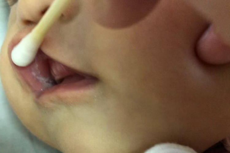 鹅口疮白色斑膜图