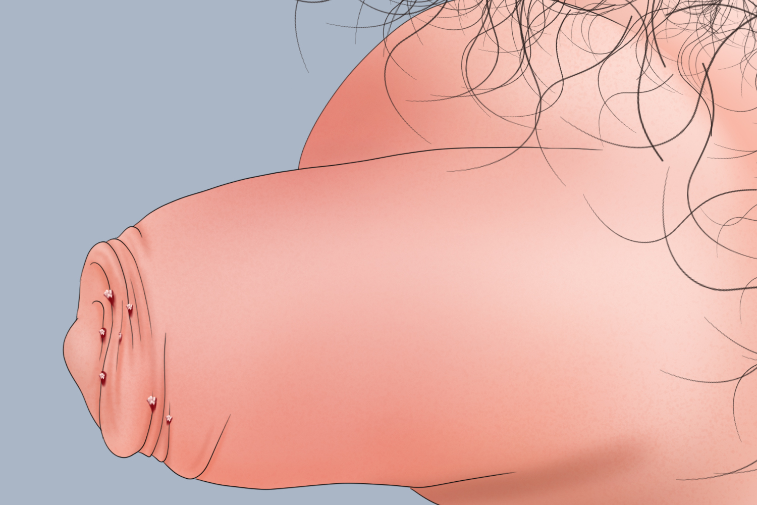 男性尖锐湿疣包皮手绘图 男性尖锐湿疣包皮手绘图