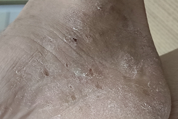 鳞屑角化型足癣脚踝皮肤粗糙图 鳞屑角化型足癣脚踝皮肤粗糙图