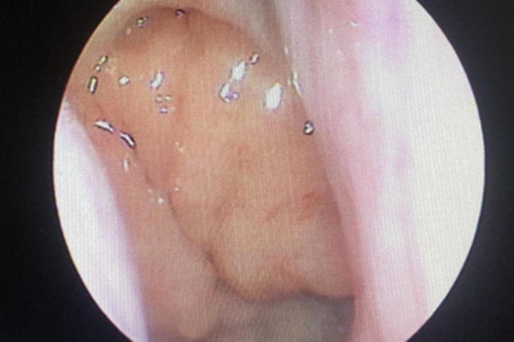腺样体肥大咽喉症状图 腺样体肥大咽喉症状图