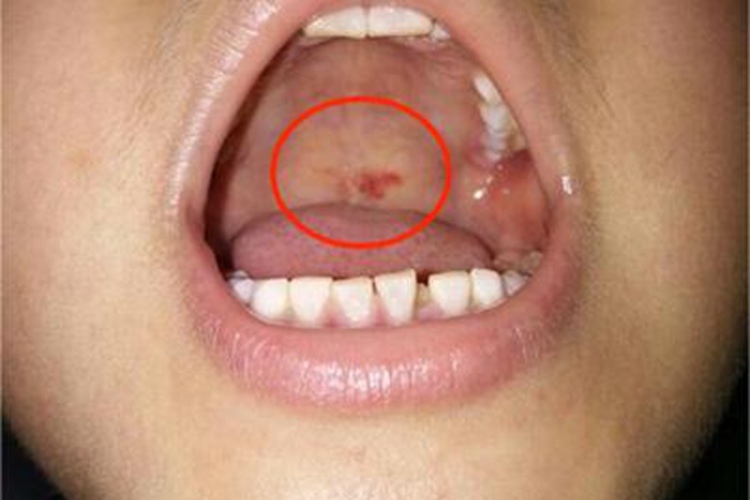 获得性风疹前驱期红斑图