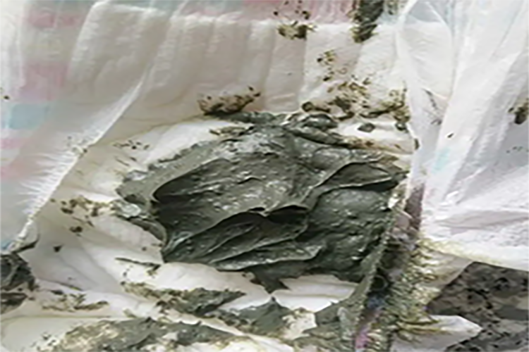 婴儿胆汁淤积症土灰色大便图