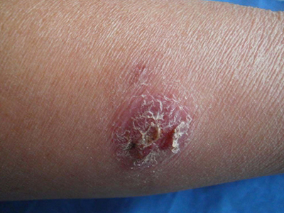 诺卡菌病胳膊长红色结节破溃结痂图