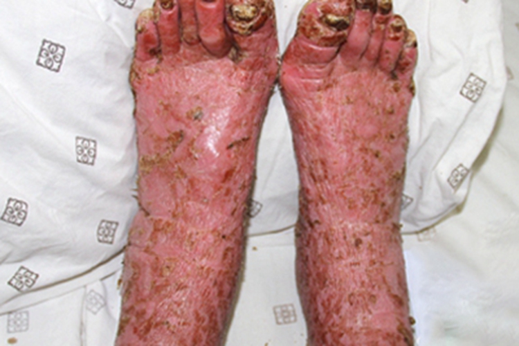 银屑病脚部红肿图