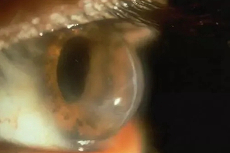 圆锥角膜角膜水肿图