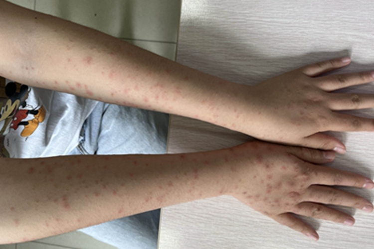 男性二期梅毒丘疹图 男性二期梅毒丘疹图