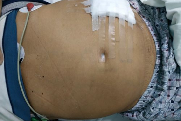 肝腹水早期腹胀图