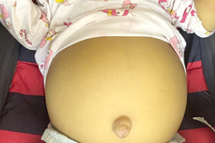 肝豆状核变性腹部症状图 肝豆状核变性腹部症状图