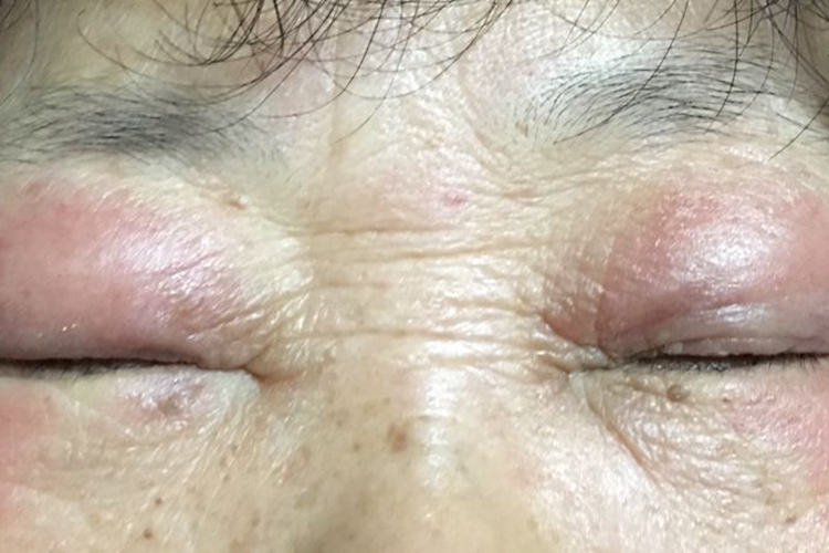 接触性睑皮炎症状图 接触性睑皮炎症状图