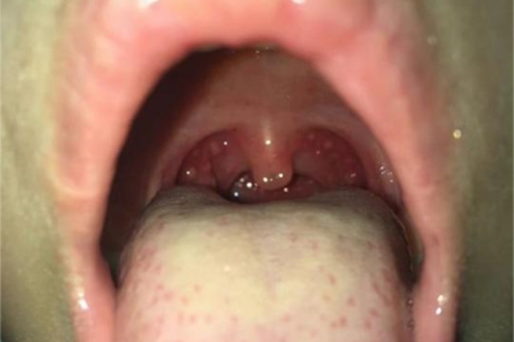 小儿疱疹性咽峡炎咽峡水肿图