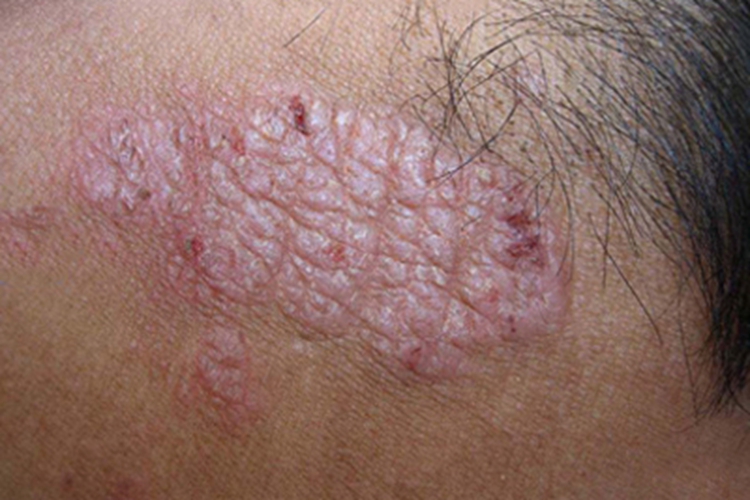 体虱病皮肤增厚图